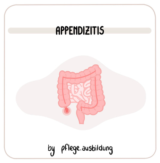 Appendizitis