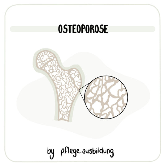 Osteoporose