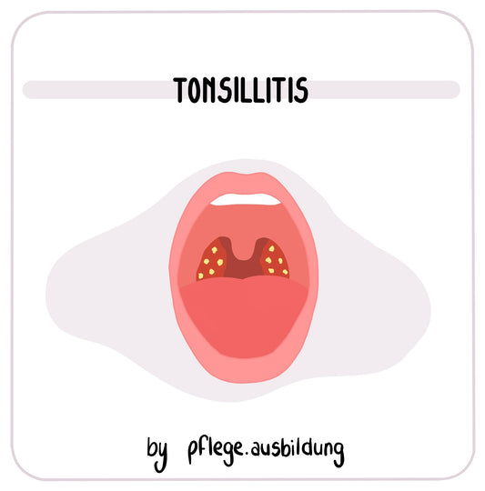 Tonsillitis
