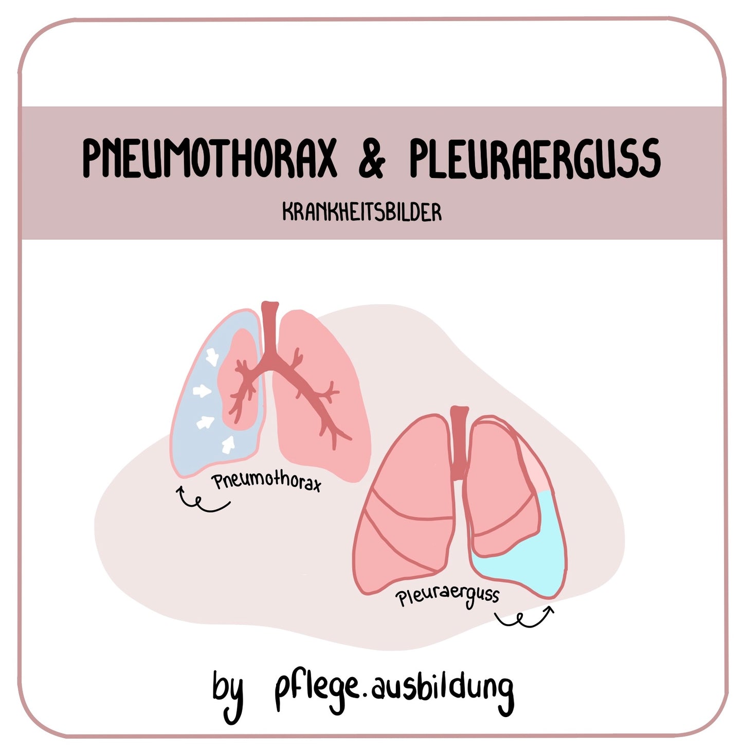 Pneumothorax & Pleuraerguss