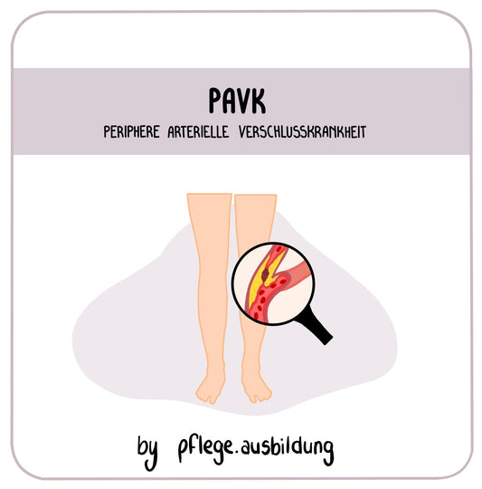 pAVK