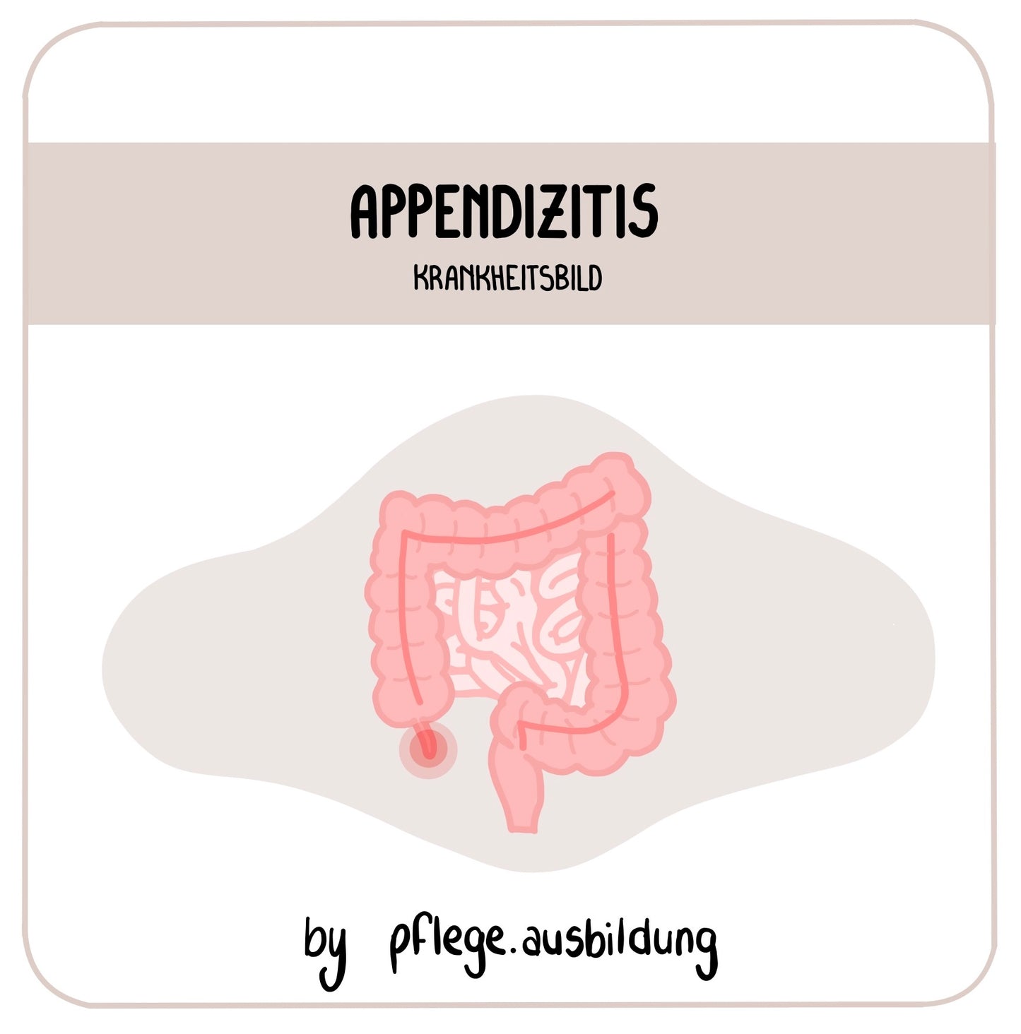 Appendizitis