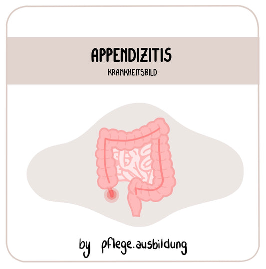 Appendizitis
