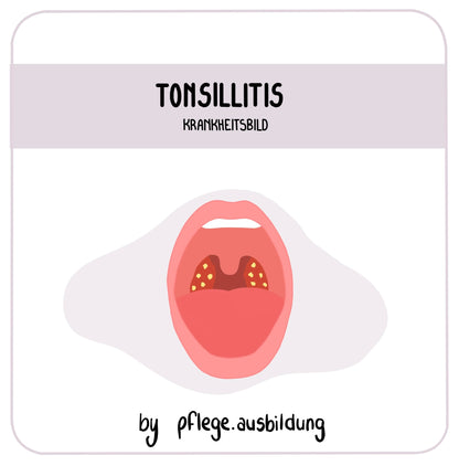 Tonsillitis