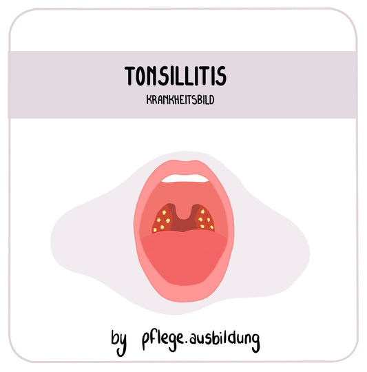 Tonsillitis