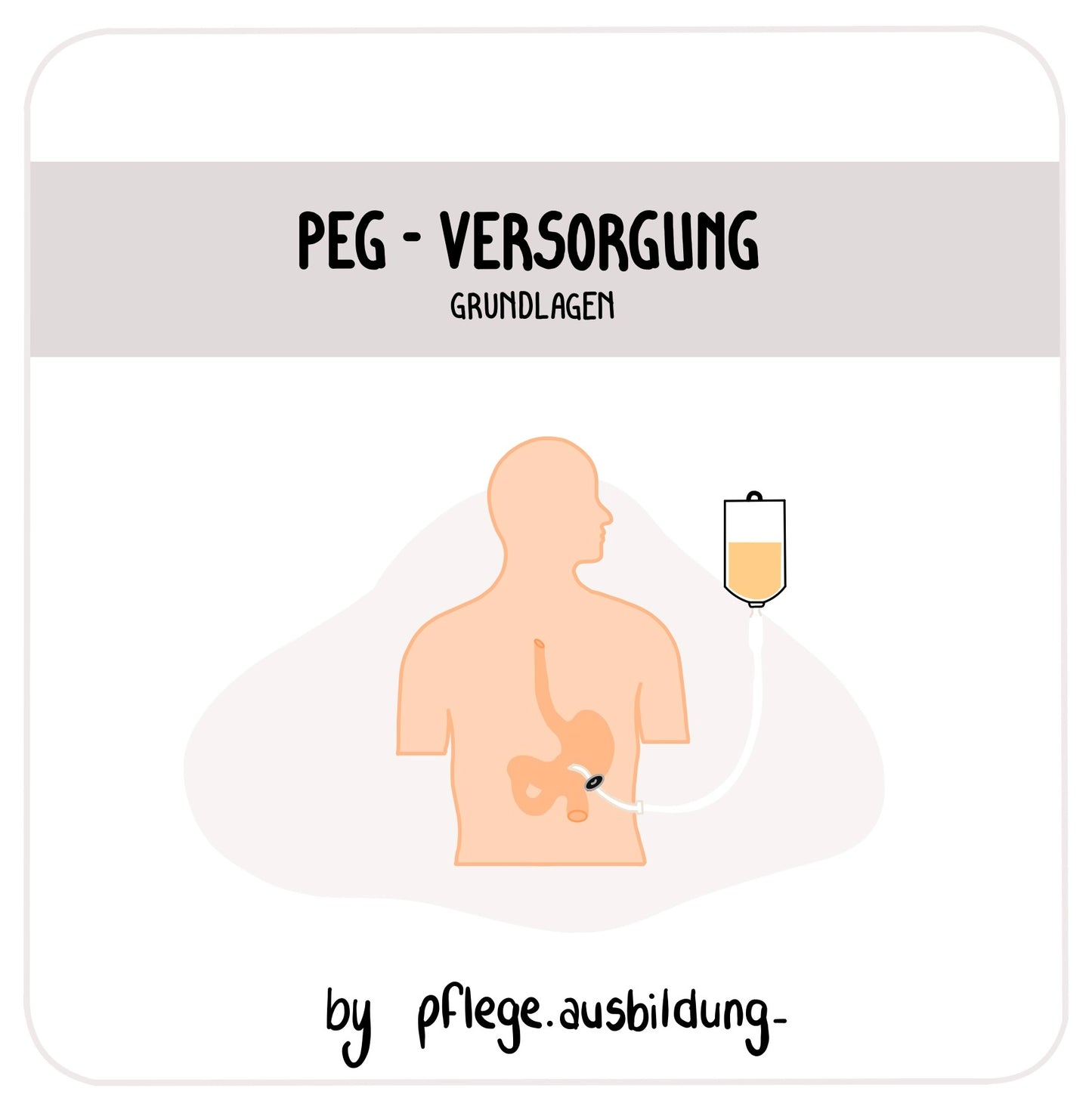 PEG-Versorgung
