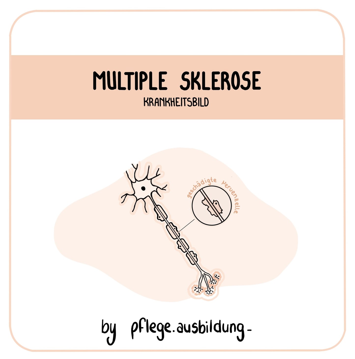 Multiple Sklerose