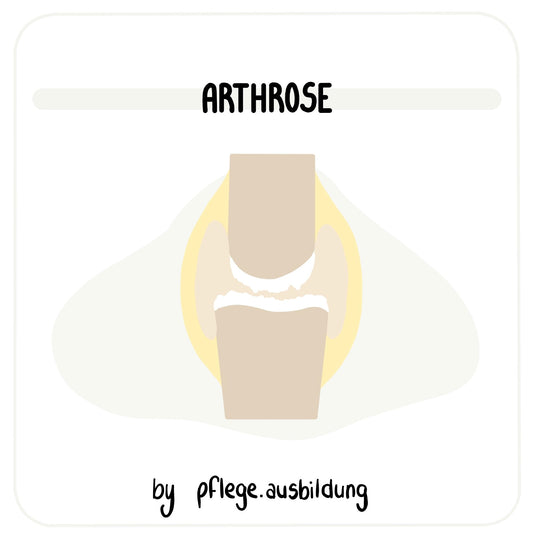 Arthrose
