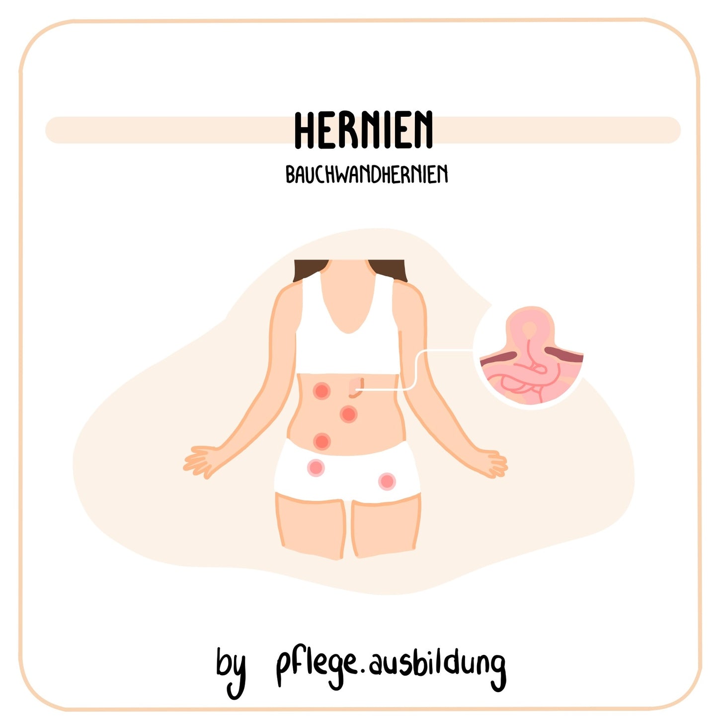 Hernien