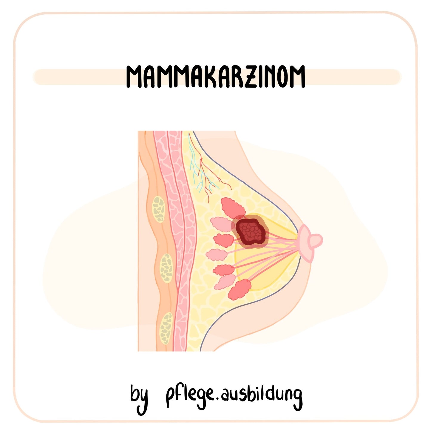 Mammakarzinom