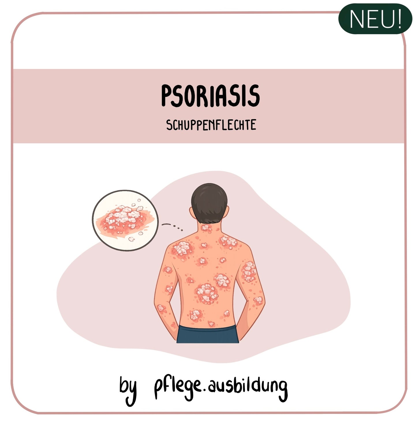Psoriasis