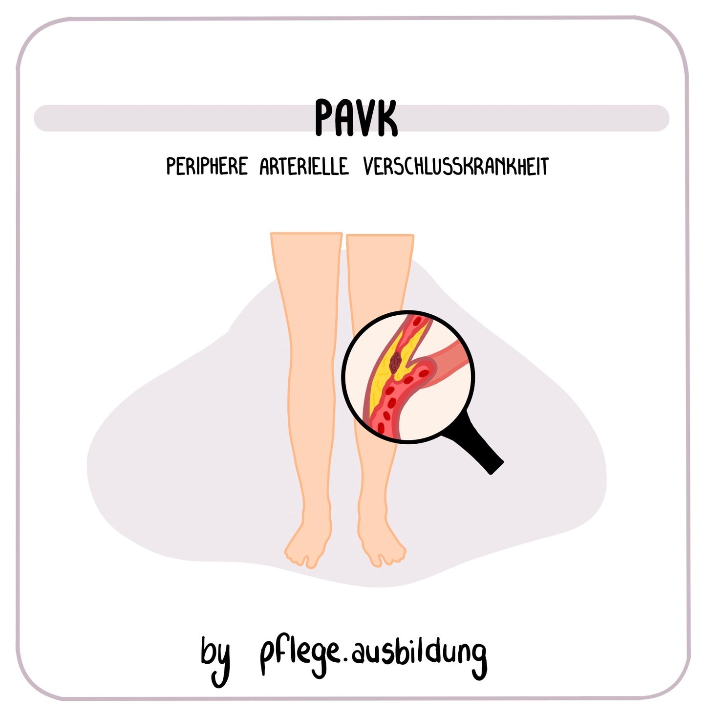 pAVK