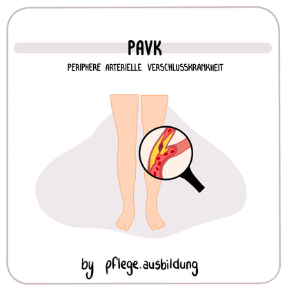 pAVK
