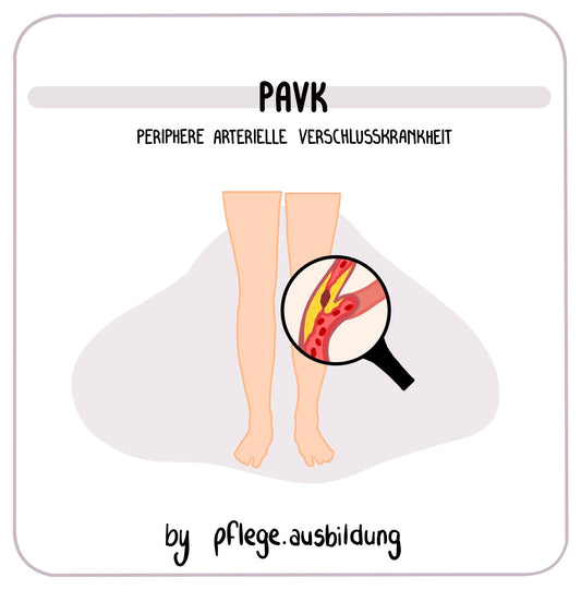 pAVK