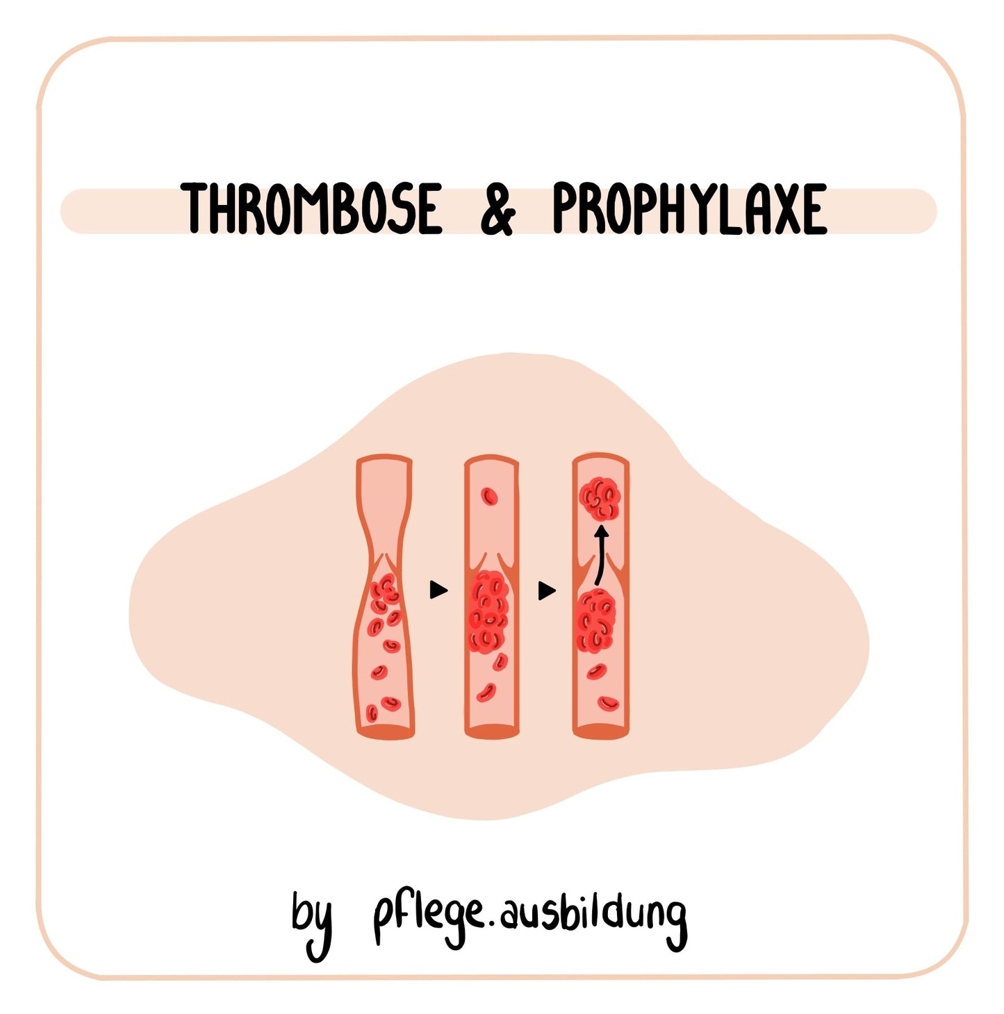 Thrombose